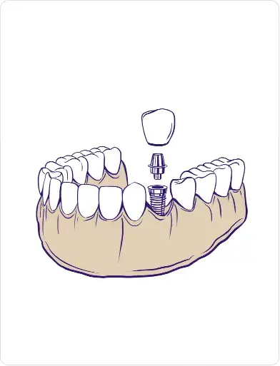Single tooth dental implants